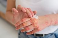 Several types of fungal infections can occur on the skin. (Image via Freepik)